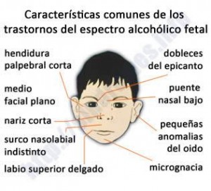 sindrome de alcoholismo fetal sintomas